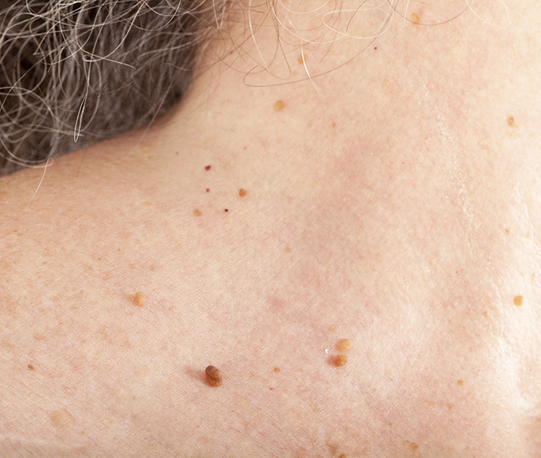 Skin Tags Removal: The Comprehensive Guide